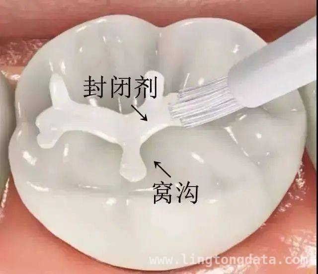 关注儿童蛀牙，东莞儿童口腔疾病综合干预项目攻略 守护孩子牙齿健康，东莞免费涂氟和窝沟封闭项目详情揭秘