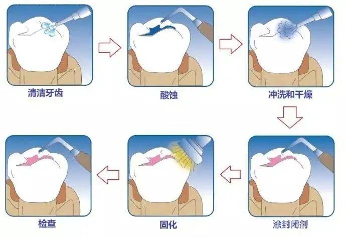 关注儿童蛀牙，东莞儿童口腔疾病综合干预项目攻略 守护孩子牙齿健康，东莞免费涂氟和窝沟封闭项目详情揭秘