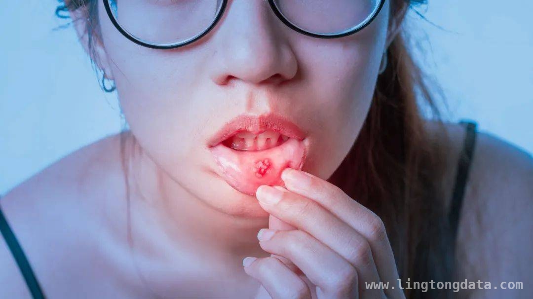 别小瞧口腔溃疡，背后可能藏着白塞病