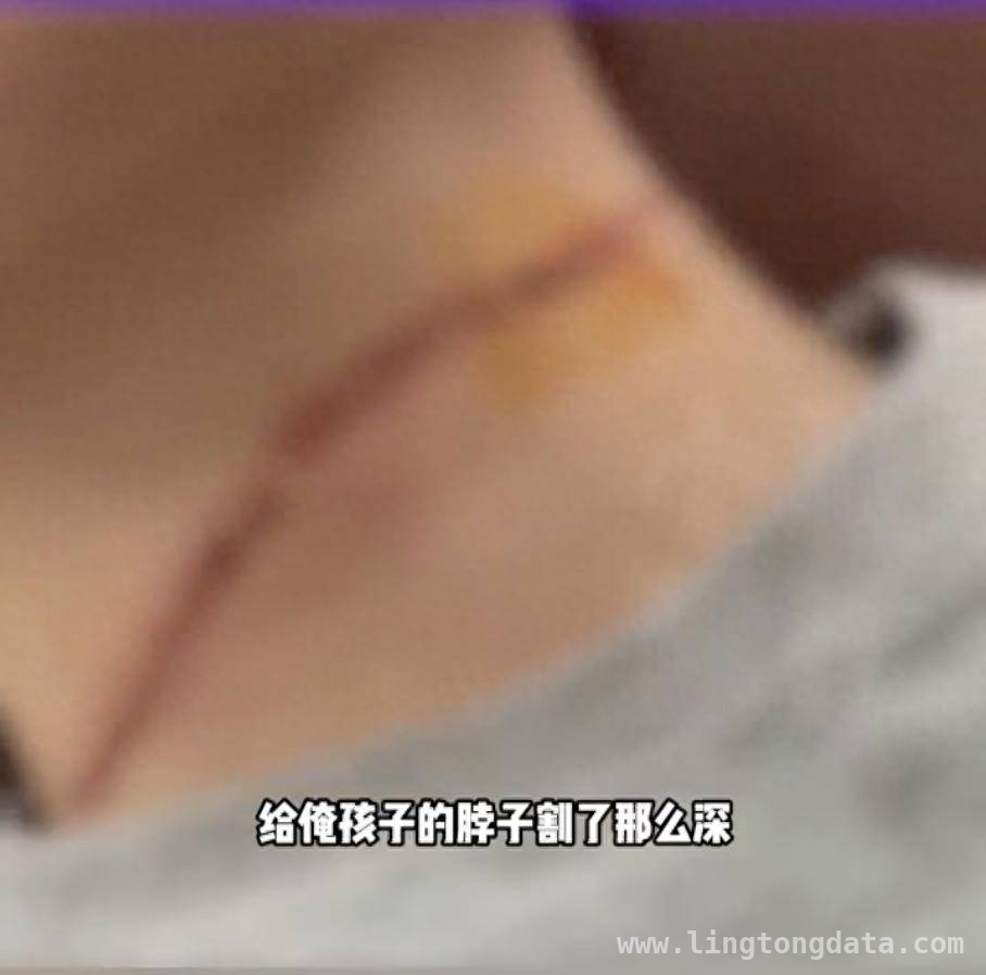 气温回暖风筝飞，紧绷风筝线割伤多人引担忧，春日风筝线成“隐形杀手”，多起伤人事件敲响警钟