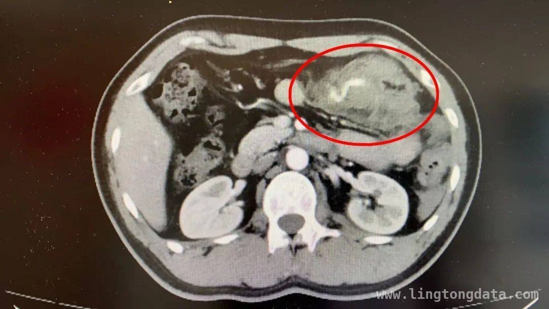 意外车祸引腹腔危机，医院团队成功拯救生命