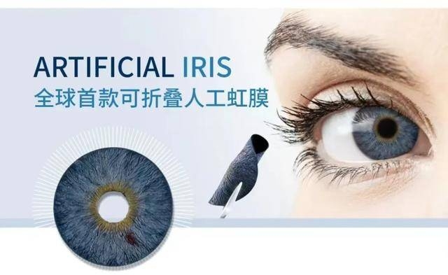 山西眼科专家跨区域施术，中西部首例人工虹膜植入助患者复明