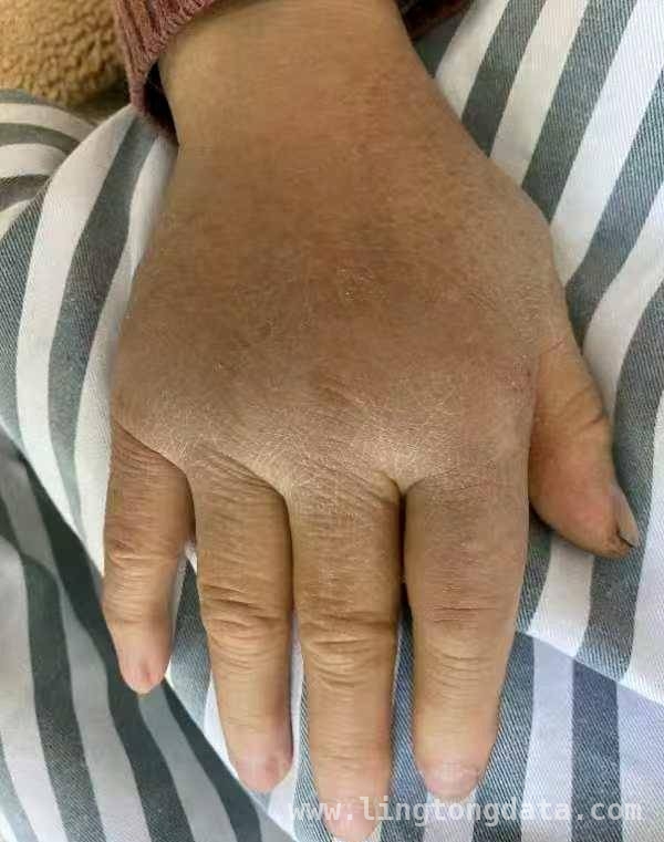 春季蛇虫活跃，清明踏青如何防蛇咬伤？