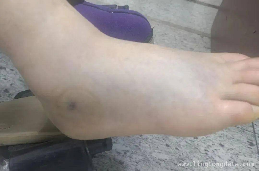春季蛇虫活跃，清明踏青如何防蛇咬伤？