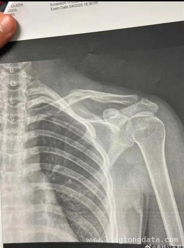 谷爱凌受伤后首晒照，伤病之下仍盼重返赛场，伤病难挡梦想！谷爱凌受伤后亮相，米兰冬奥会仍有希望