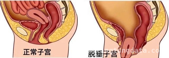 别让盆底器官脱垂，偷走你的健康与幸福！，王奶奶的“下坠”困扰：盆底器官脱垂全解析