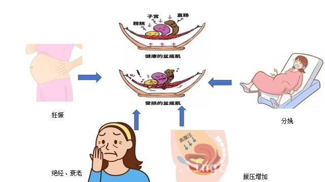 别让盆底器官脱垂，偷走你的健康与幸福！，王奶奶的“下坠”困扰：盆底器官脱垂全解析