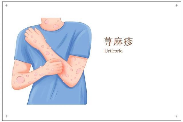从过敏案例看：如何躲开过敏原，守护健康？，警惕！过敏可能在几小时内致命